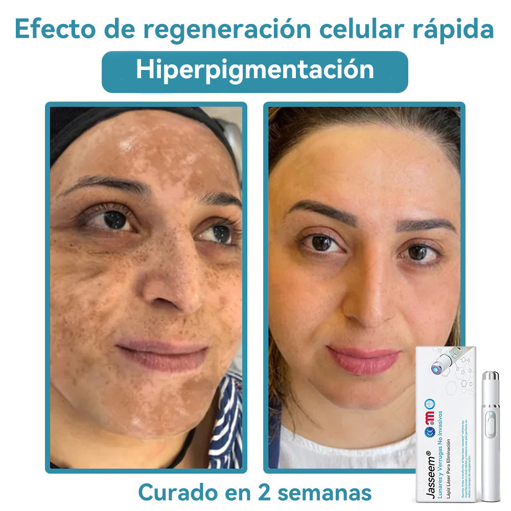 𝐉𝐚𝐬𝐬𝐞𝐞𝐦® Lápiz Láser de Grado Médico 💕 (Tecnología Láser de Dióxido de Carbono – Eficaz para Eliminar Lunares, Verrugas, Excesos de Piel, Manchas de Pigmentación y Otros Defectos de la Piel) 🔥