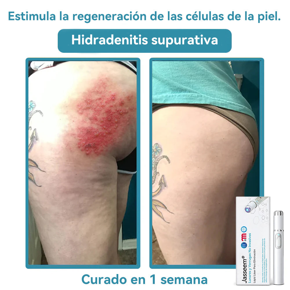 𝐉𝐚𝐬𝐬𝐞𝐞𝐦® Lápiz Láser de Grado Médico 💕 (Tecnología Láser de Dióxido de Carbono – Eficaz para Eliminar Lunares, Verrugas, Excesos de Piel, Manchas de Pigmentación y Otros Defectos de la Piel) 🔥