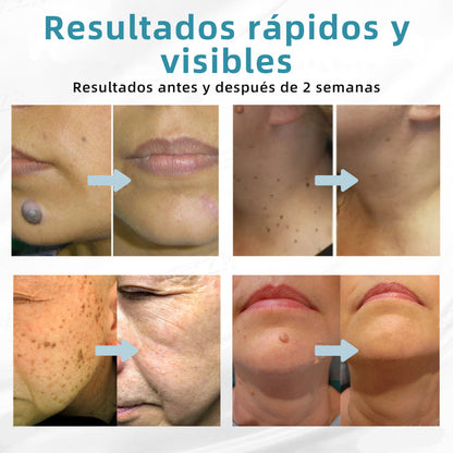 𝐉𝐚𝐬𝐬𝐞𝐞𝐦® Lápiz Láser de Grado Médico 💕 (Tecnología Láser de Dióxido de Carbono – Eficaz para Eliminar Lunares, Verrugas, Excesos de Piel, Manchas de Pigmentación y Otros Defectos de la Piel) 🔥