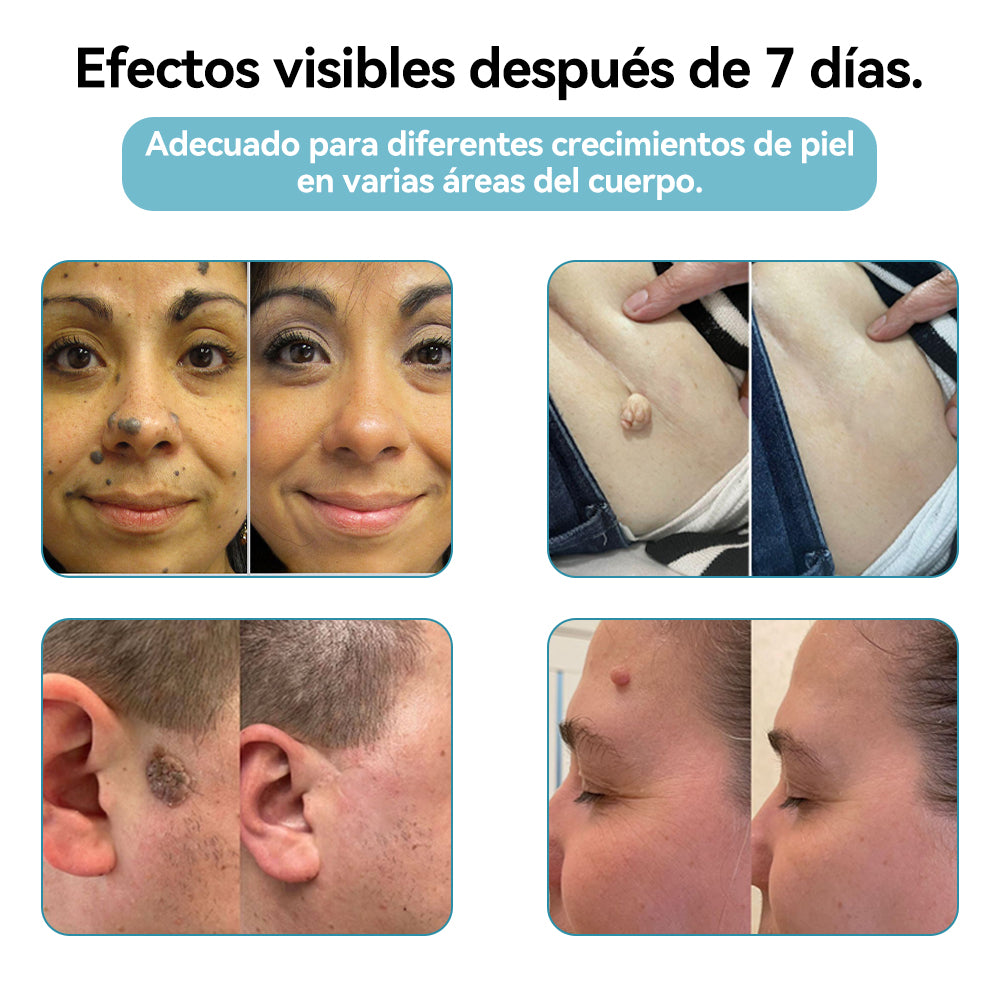 𝐉𝐚𝐬𝐬𝐞𝐞𝐦® Lápiz Láser de Grado Médico 💕 (Tecnología Láser de Dióxido de Carbono – Eficaz para Eliminar Lunares, Verrugas, Excesos de Piel, Manchas de Pigmentación y Otros Defectos de la Piel) 🔥