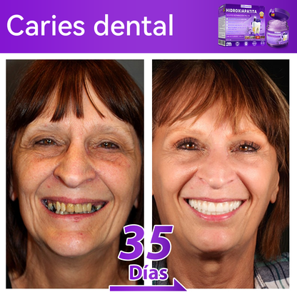 Tienda Oficial🍀|𝐷𝑜𝑟𝑚𝑜𝑟𝑛𝑎® 𝐻𝑖𝑑𝑟𝑜𝑥𝑖𝑎𝑝𝑎𝑡𝑖𝑡𝑎 𝐷𝑖𝑒𝑛𝑡𝑒𝑠 𝑅𝑒𝑝𝑎𝑟𝑎𝑐𝑖ó𝑛 𝑃𝑜𝑙𝑣𝑜🦷（Última media hora de la oferta limitada）