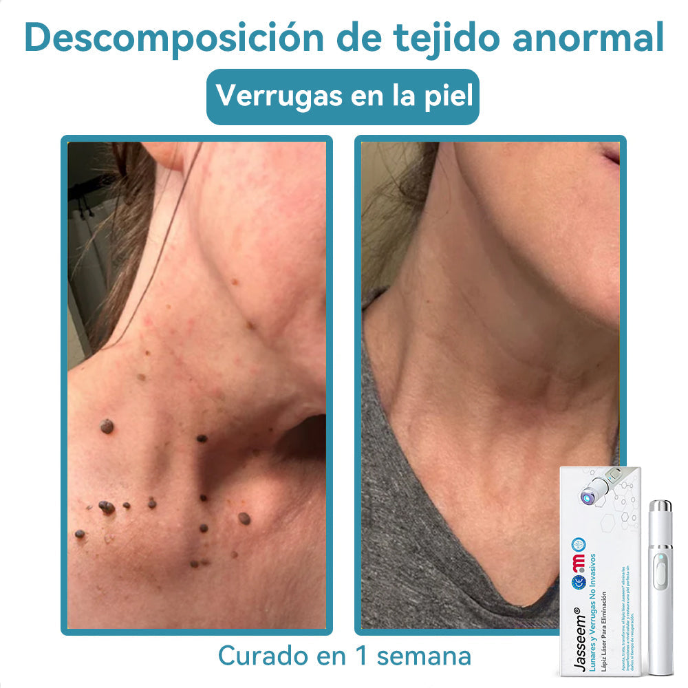 𝐉𝐚𝐬𝐬𝐞𝐞𝐦® Lápiz Láser de Grado Médico 💕 (Tecnología Láser de Dióxido de Carbono – Eficaz para Eliminar Lunares, Verrugas, Excesos de Piel, Manchas de Pigmentación y Otros Defectos de la Piel) 🔥